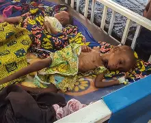 Bourem : Plus de 3.200 cas de malnutrition enregistrés chez les enfants